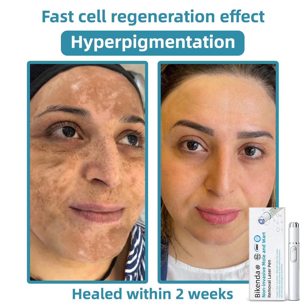 CO2 Laser Pen for Skin Blemish Removal – At-Home Precision Spot Treatment