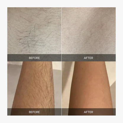 Removex – Painless Hair Removal for Silky Smooth Skin [50% Off]