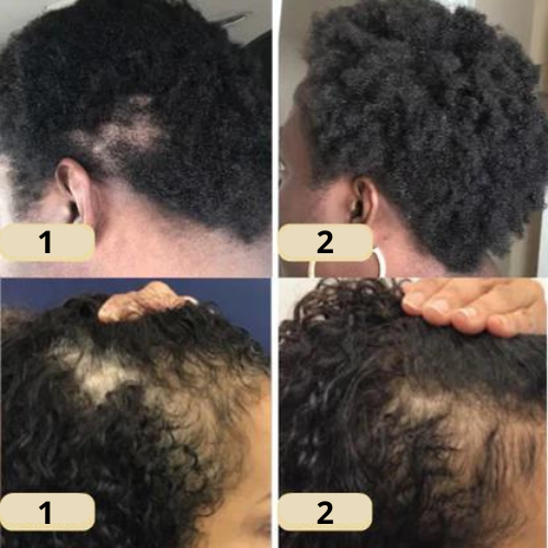 Natural Hair Growth Oil with 11 Plant Oils for Thicker, Fuller Hair