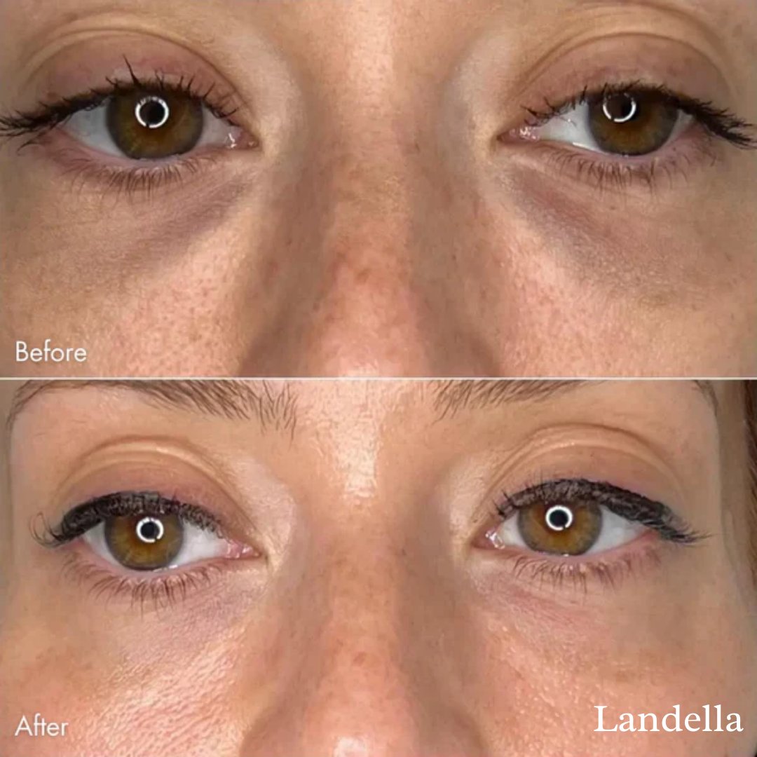 1+1 Free | SmoothGaze™ Awaken Under Eyes