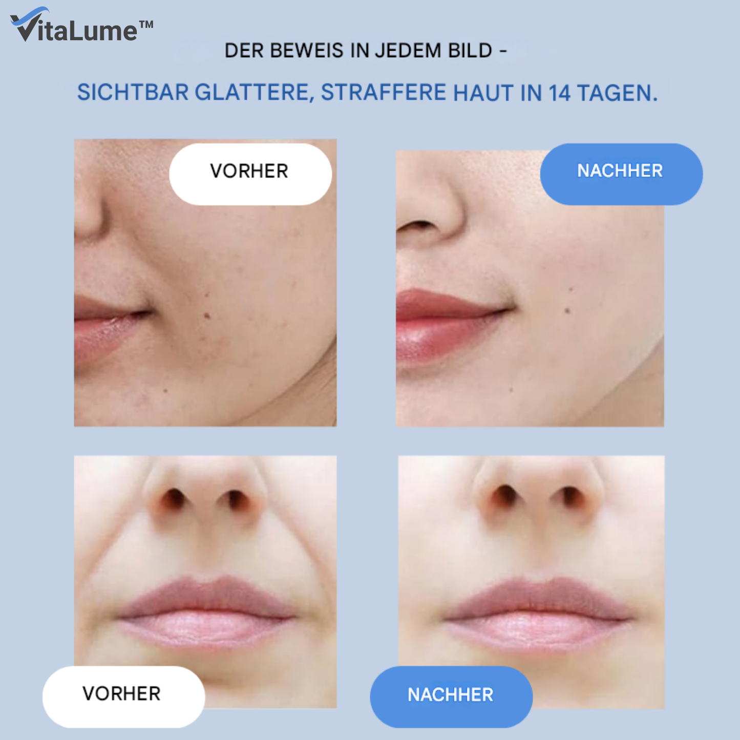 VitaLume™ – Wrinkle Patches with Microcrystals and Hyaluronic Acid for Intensive and Smoothing Care [1 + 1 Free]