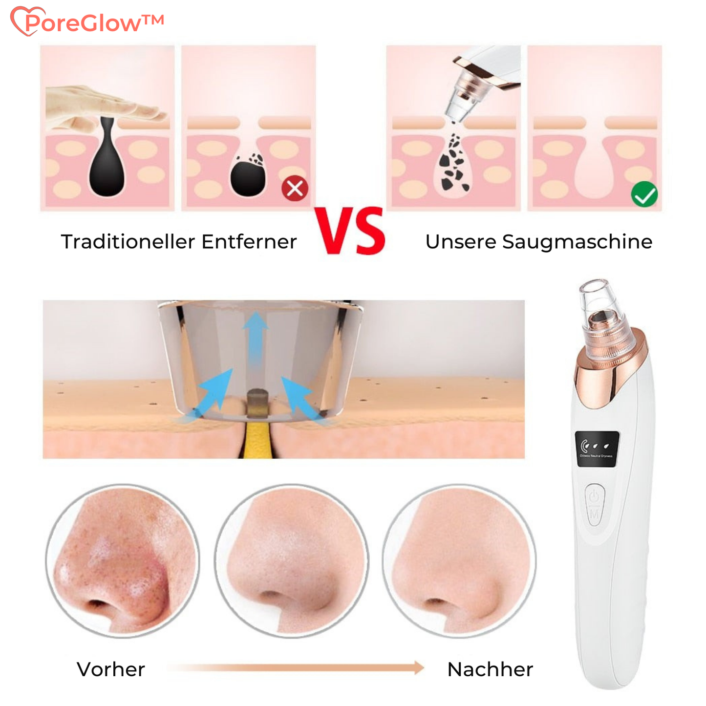 PoreGlow™ – Blackhead Removal Set for Thorough and Effective Skin Cleansing [50% Discount]