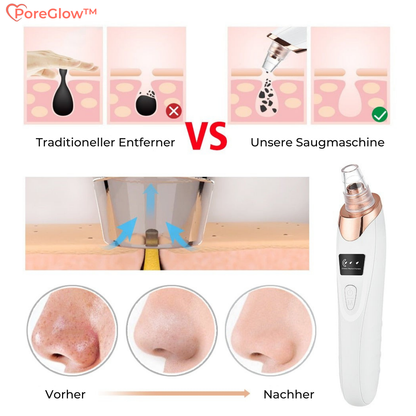 PoreGlow™ – Blackhead Removal Set for Thorough and Effective Skin Cleansing [50% Discount]