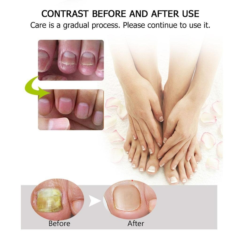Nail Strengthening Gel for Brittle & Discoloured Nails – 2 Pack
