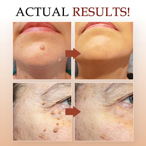 Natural Tea Tree Oil Skin Tag & Wart Removal Serum – Home Use