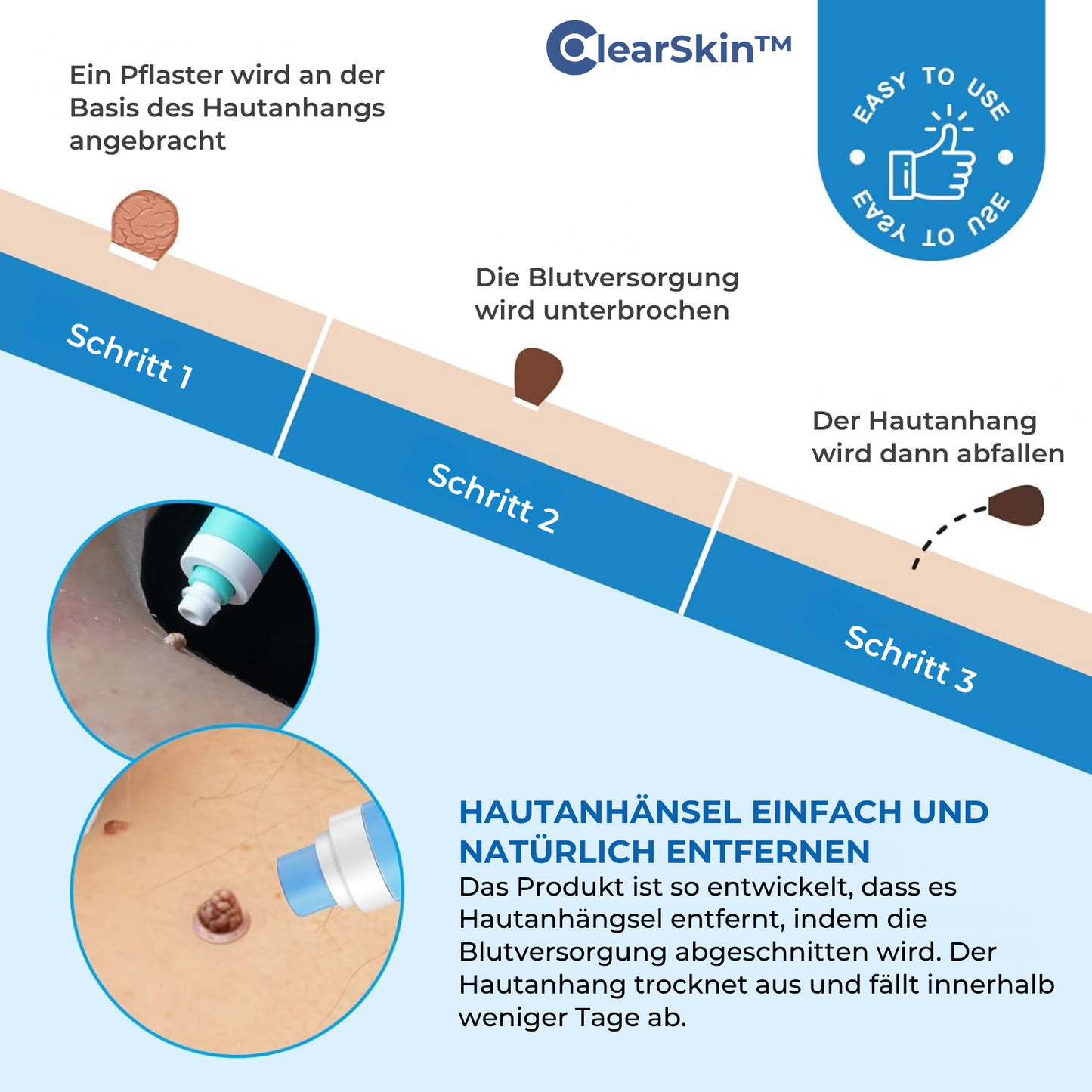 ClearSkin™ – Wart Removal Pen for Fast, Effective & Gentle Skin Treatment [50% Off]
