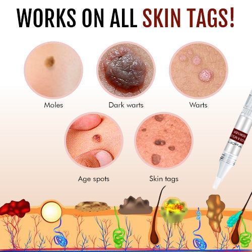 Natural Tea Tree Oil Skin Tag & Wart Removal Serum – Home Use