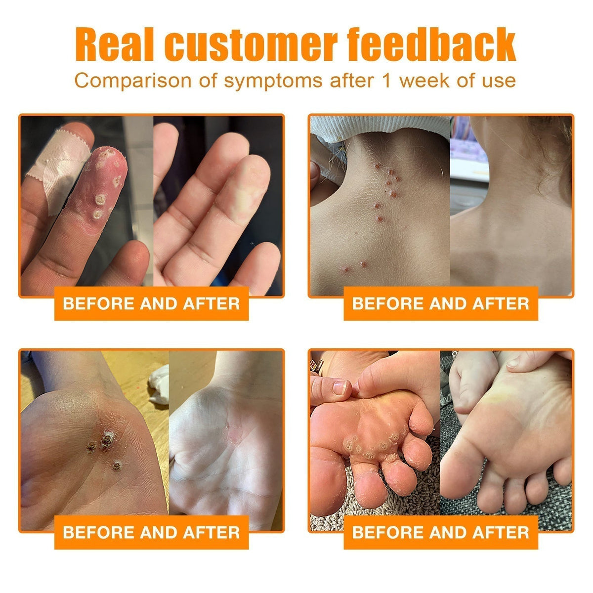Bee Venom Skin Tag Removal Treatment – Natural Wart & Mole Remover
