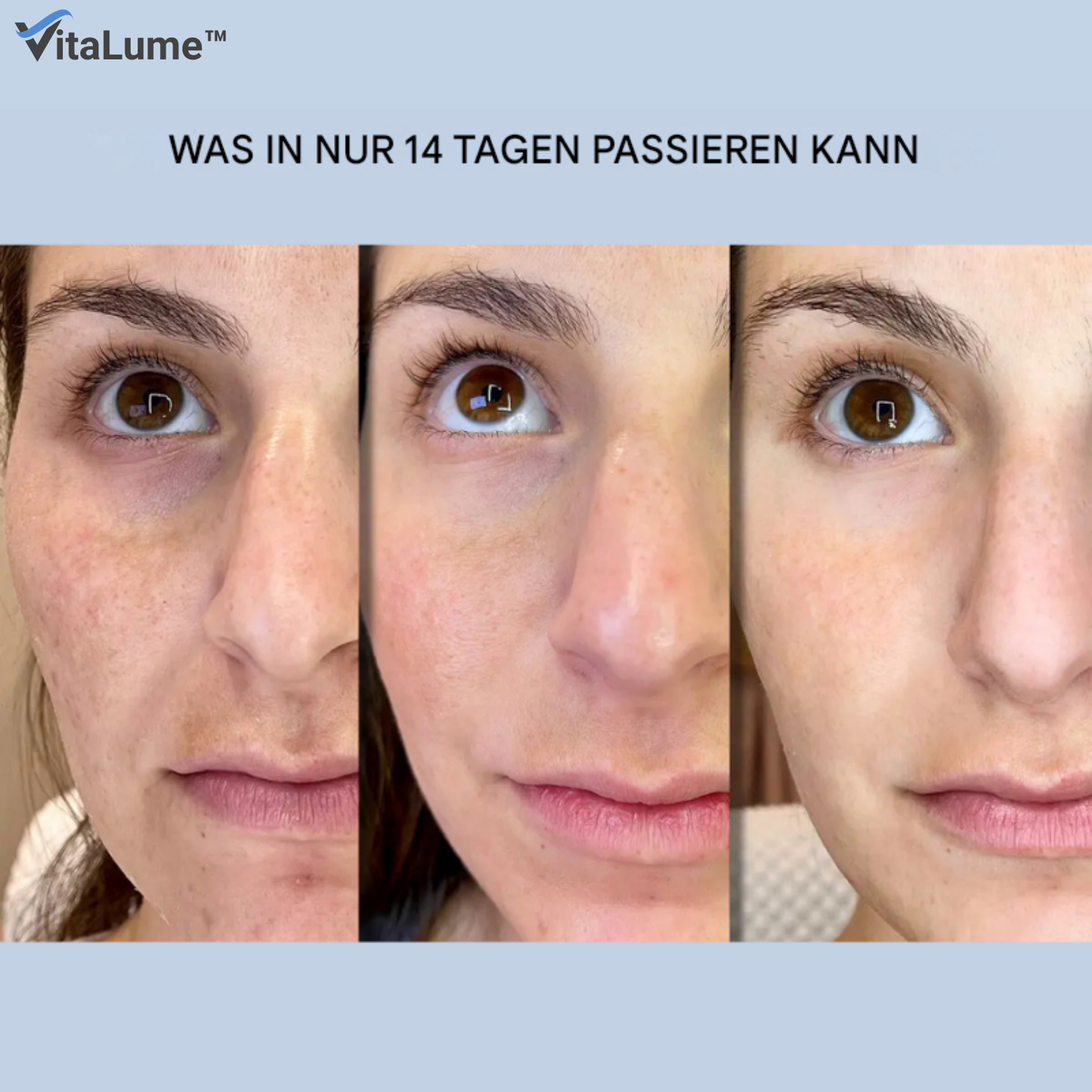 VitaLume™ – Wrinkle Patches with Microcrystals and Hyaluronic Acid for Intensive and Smoothing Care [1 + 1 Free]
