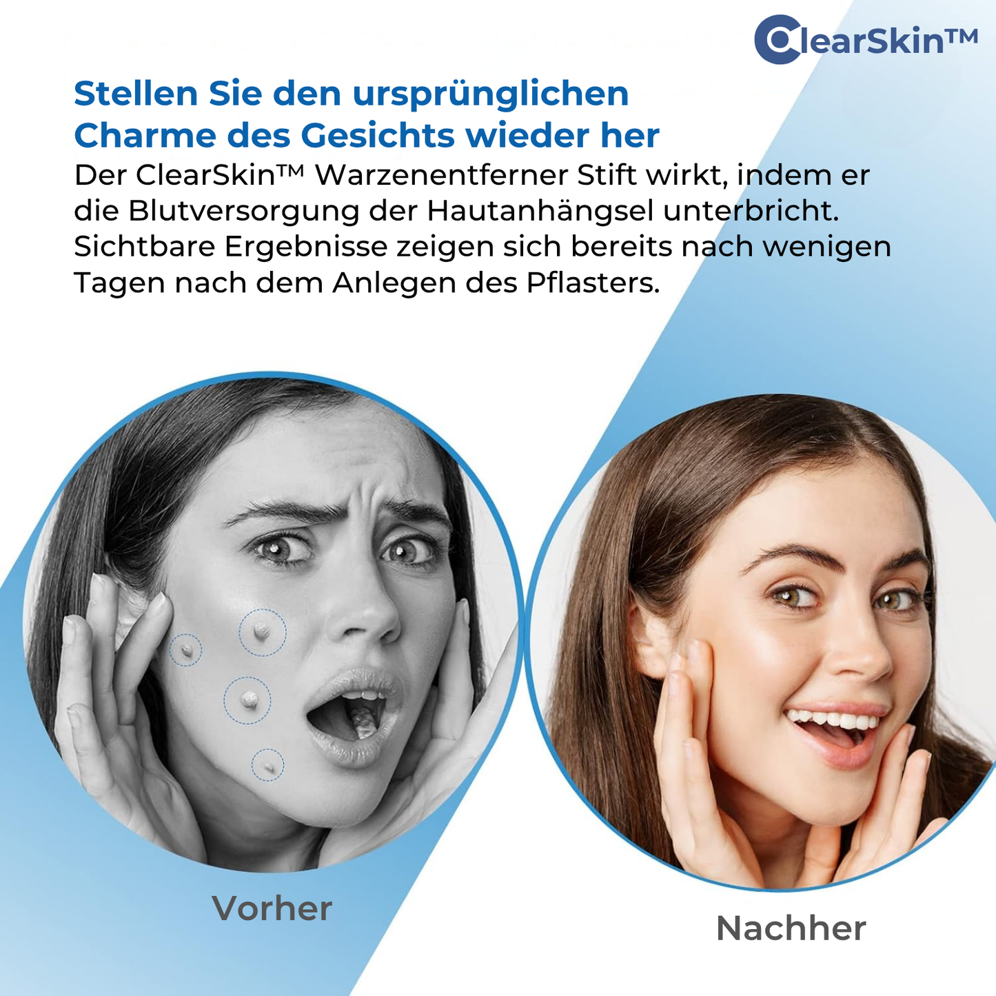ClearSkin™ – Wart Removal Pen for Fast, Effective & Gentle Skin Treatment [50% Off]