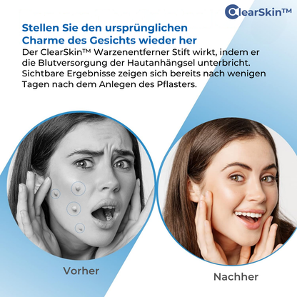 ClearSkin™ – Wart Removal Pen for Fast, Effective & Gentle Skin Treatment [50% Off]