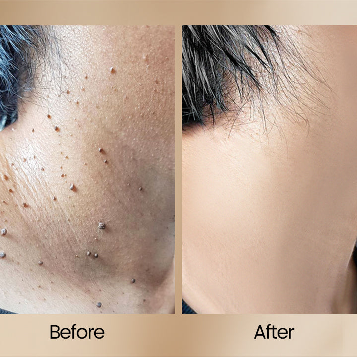 ClearSkin™ – Bee Venom Wart Removal Spray: Effective, Fast, and Gentle [50% Off]