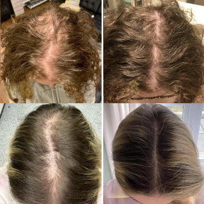 GrowEssence™ – Natural Solution for Hair Growth for Strong, Healthy & Full Hair [1 + 1 Free]