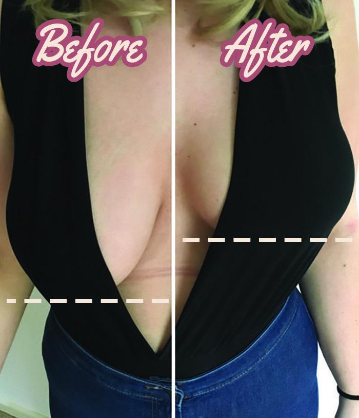 Collagen Breast Lifting Patches – Plant-Based Firming Skin Care