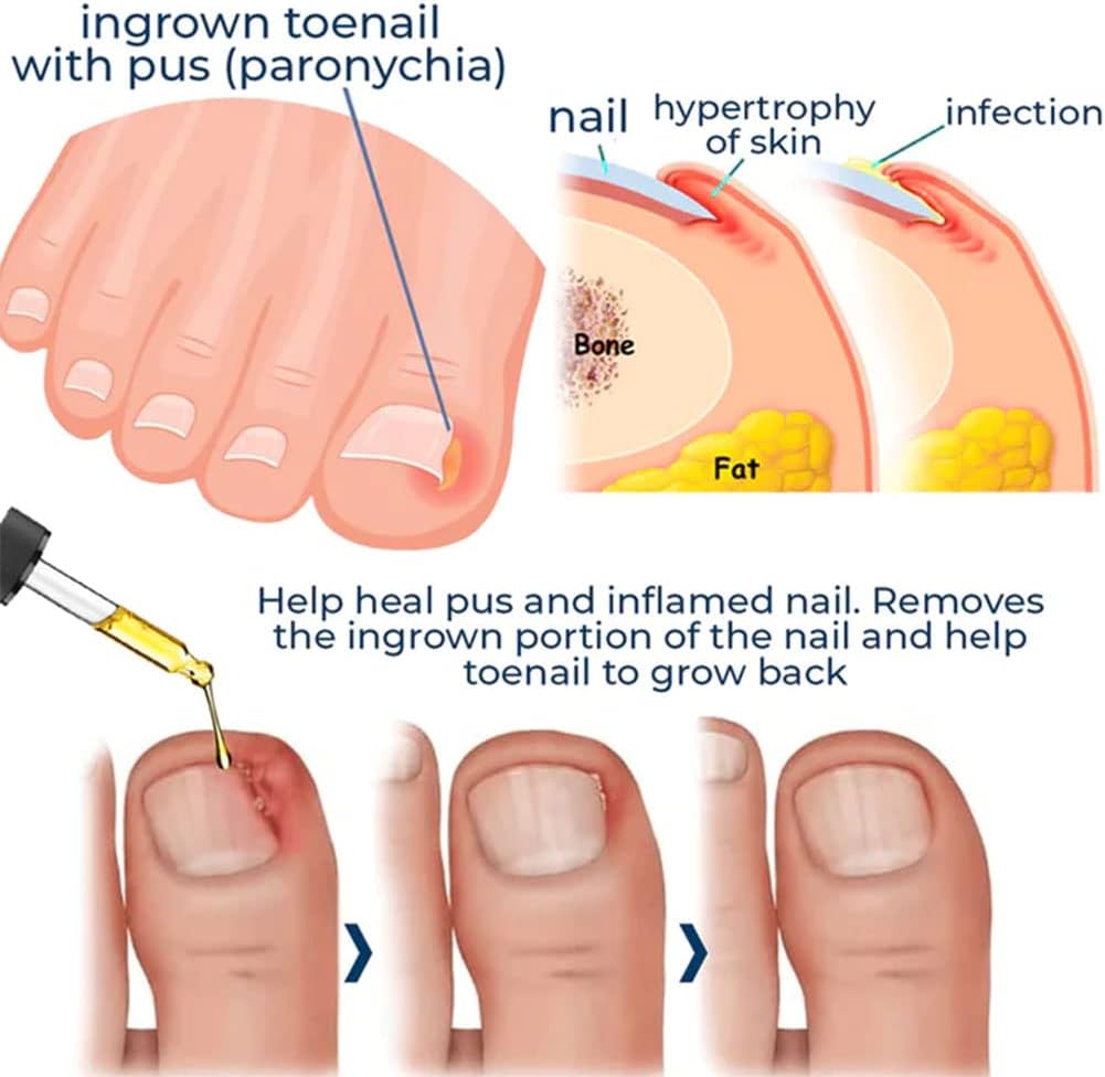 HealDrop™ - Repairs damaged nails within 4 weeks [1 + 1 Free]