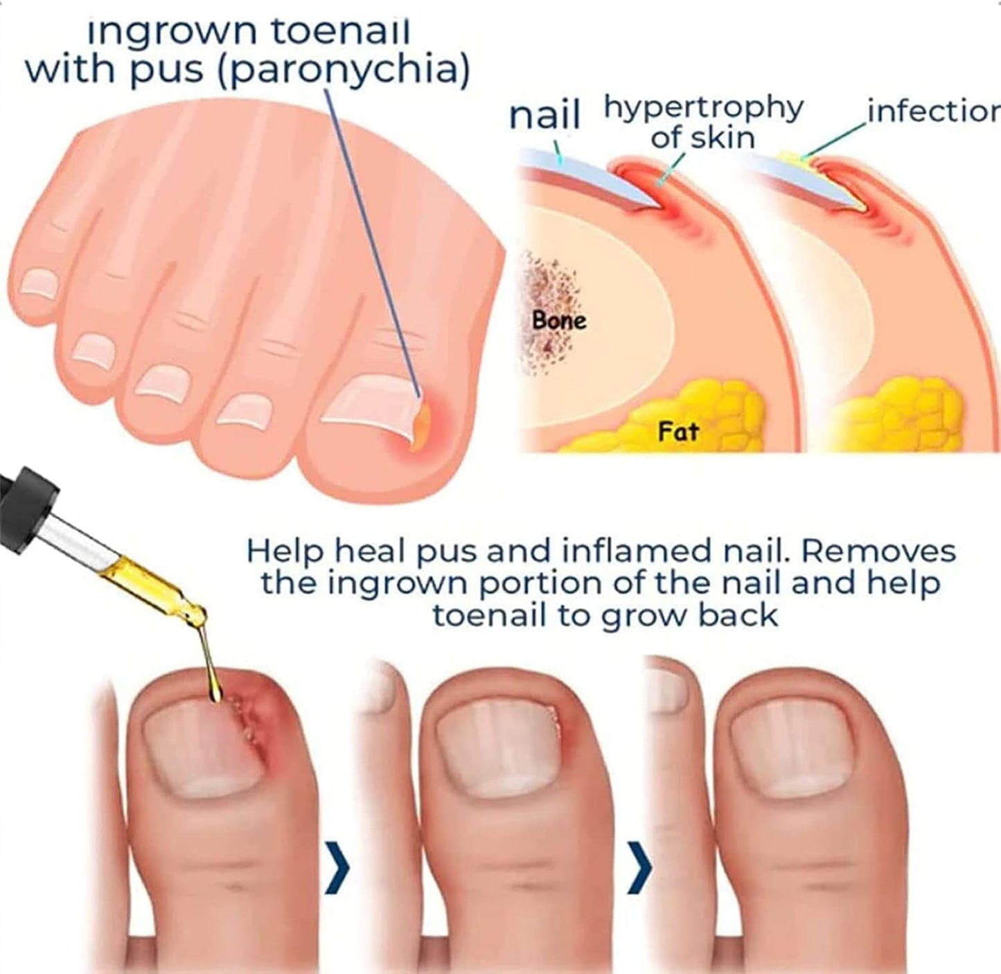 ToePerfect™ Intensive Care for Well-Groomed Toenails & Fingernails [1 + 1 Free]