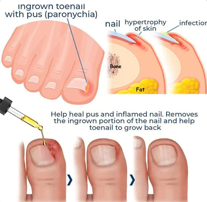 ToePerfect™ Intensive Care for Well-Groomed Toenails & Fingernails [1 + 1 Free]