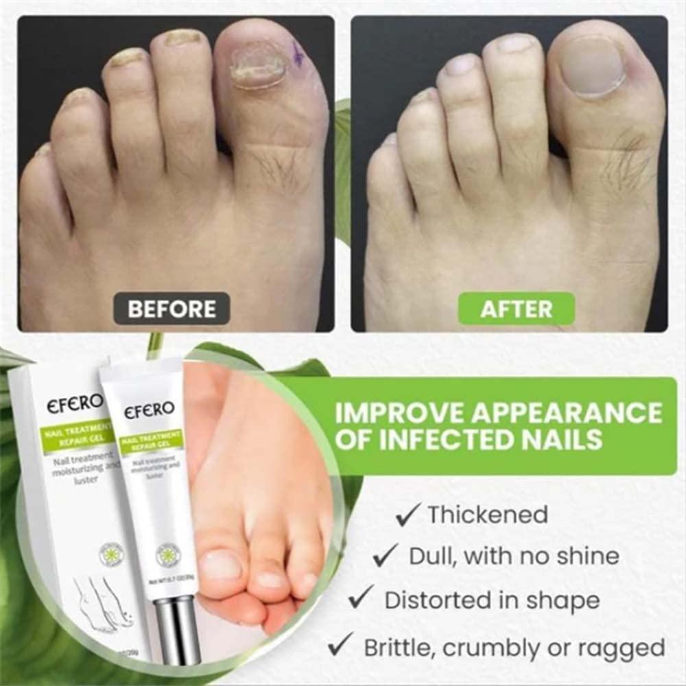 RejuveNail™ – Strengthens Healthy, Beautiful Nails Long-Term [1 + 1 Free]