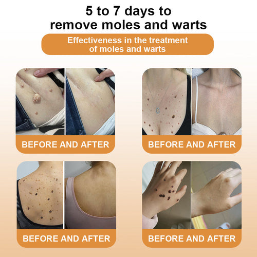 Bee Venom Skin Tag Removal Treatment – Natural Wart & Mole Remover