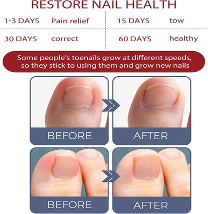 ToePerfect™ Intensive Care for Well-Groomed Toenails & Fingernails [1 + 1 Free]