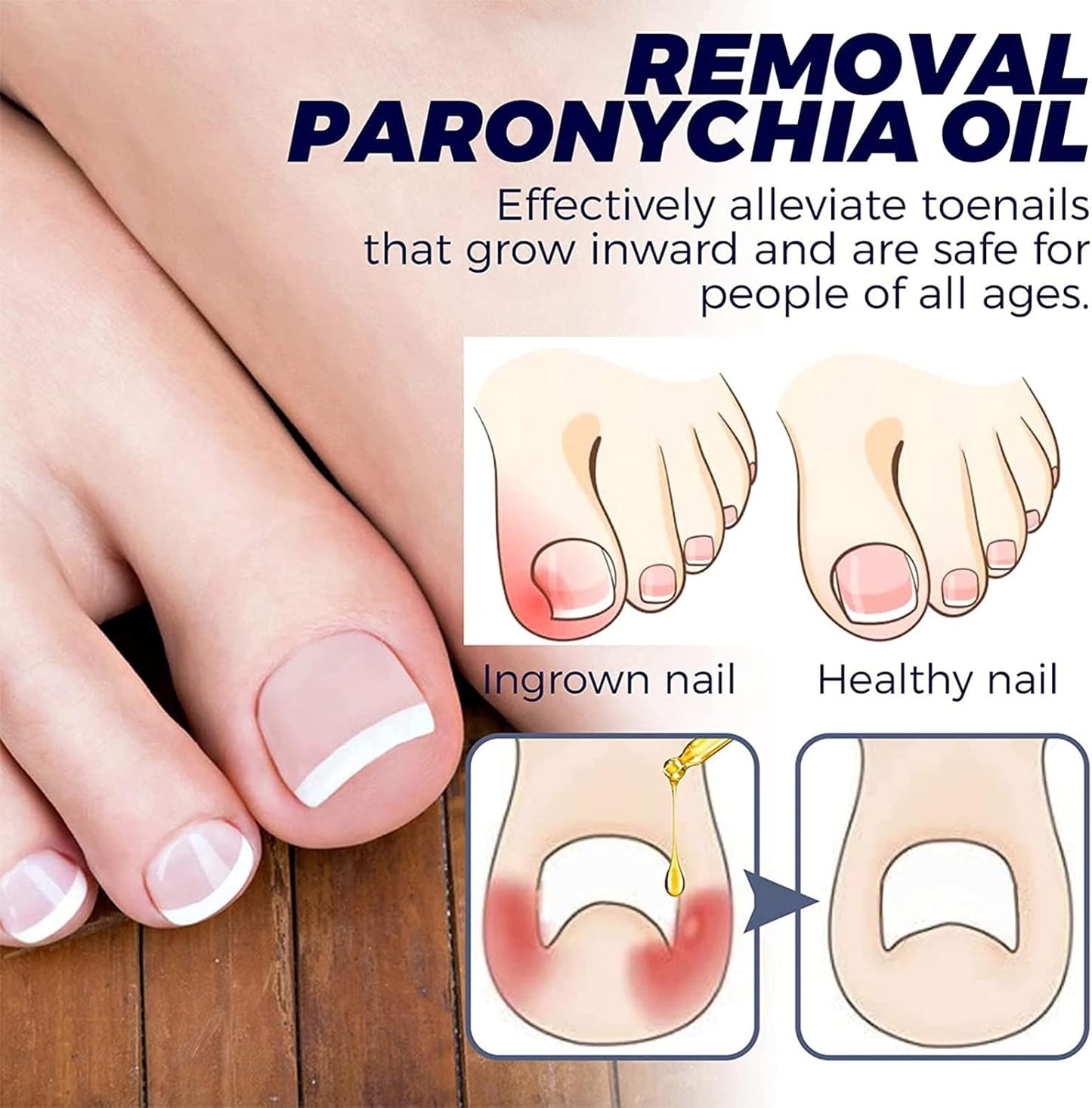 ToePerfect™ Intensive Care for Well-Groomed Toenails & Fingernails [1 + 1 Free]