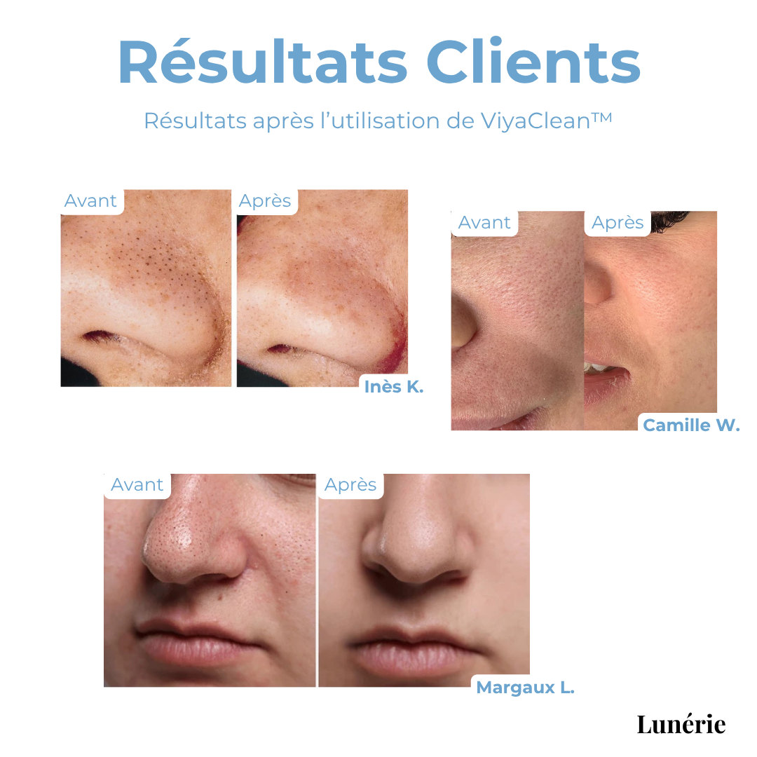 SkinClear™ – Deep pore cleansing serum with salicylic acid & natural extracts [50% Off]