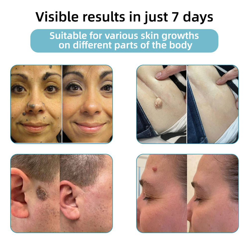 CO2 Laser Pen for Skin Blemish Removal – At-Home Precision Spot Treatment