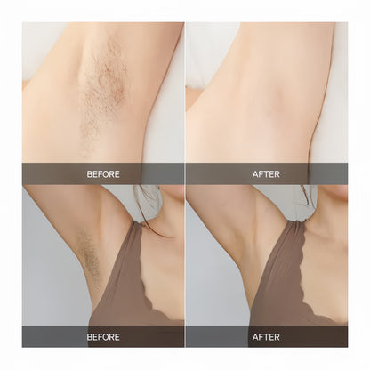 Removex – Painless Hair Removal for Silky Smooth Skin [50% Off]