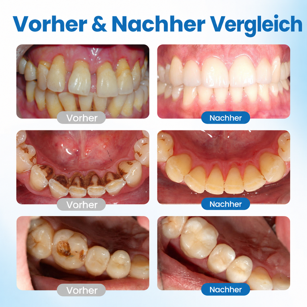 Nano-Hydroxyapatite Tooth Enamel Serum for Sensitive Teeth