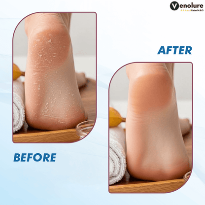 ClearFeel™ – Electric Callus Remover for Silky Smooth Feet & Boosted Confidence [50% Off]