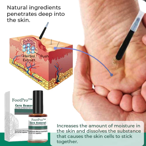 Corn Removal Gel | Extra Strength Formula | Precision Applicator | FootPro