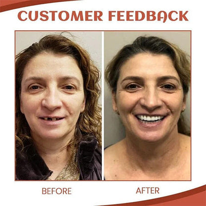 Dental Prosthesis Silicone Set | Custom-Fit Denture Liner | Soft & Non-Toxic Comfort Gel