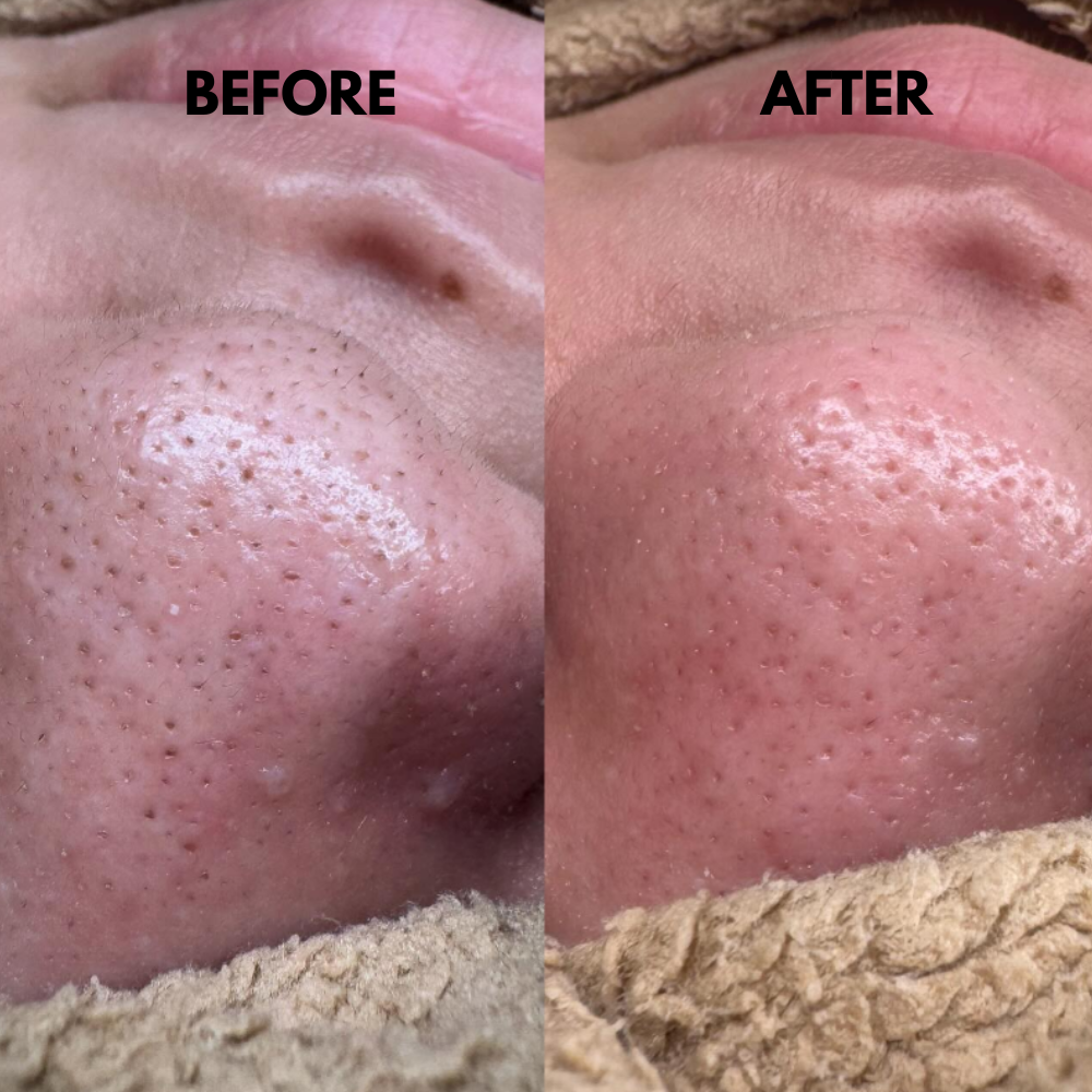 SkinSonic™ – Ultrasonic skin scrubber for deep cleansing, gentle care & radiant skin [50% Discount]