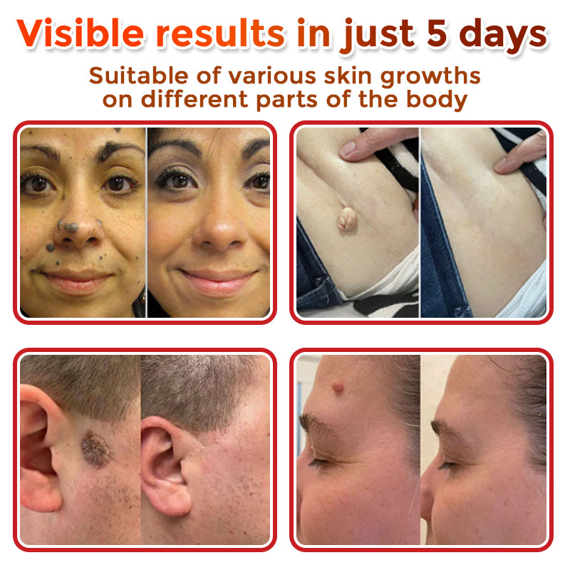 Micro Patch Skin Tag Removal Kit – Gentle At-Home Treatment (9 Patches)