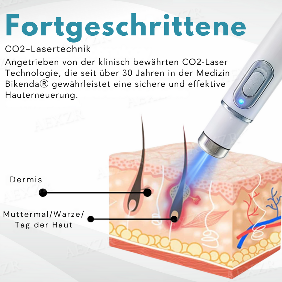 CO2 Laser Skin Tag & Mole Removal Pen for Home Use