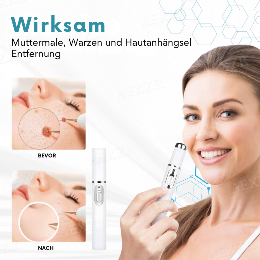 CO2 Laser Skin Tag & Mole Removal Pen for Home Use