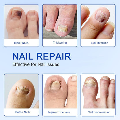 Nail Fungus Patches | Antifungal Nail Care | Overnight Repair | Nailox