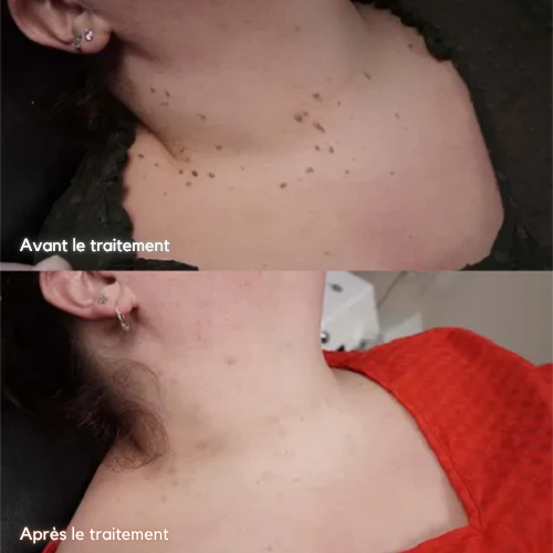 Bee Venom & Aloe Vera Skin Tag Removal Serum for Blemishes