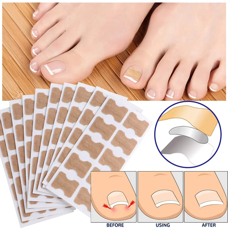 Nail Correction Strips for Ingrown & Uneven Nails – 50 Pieces