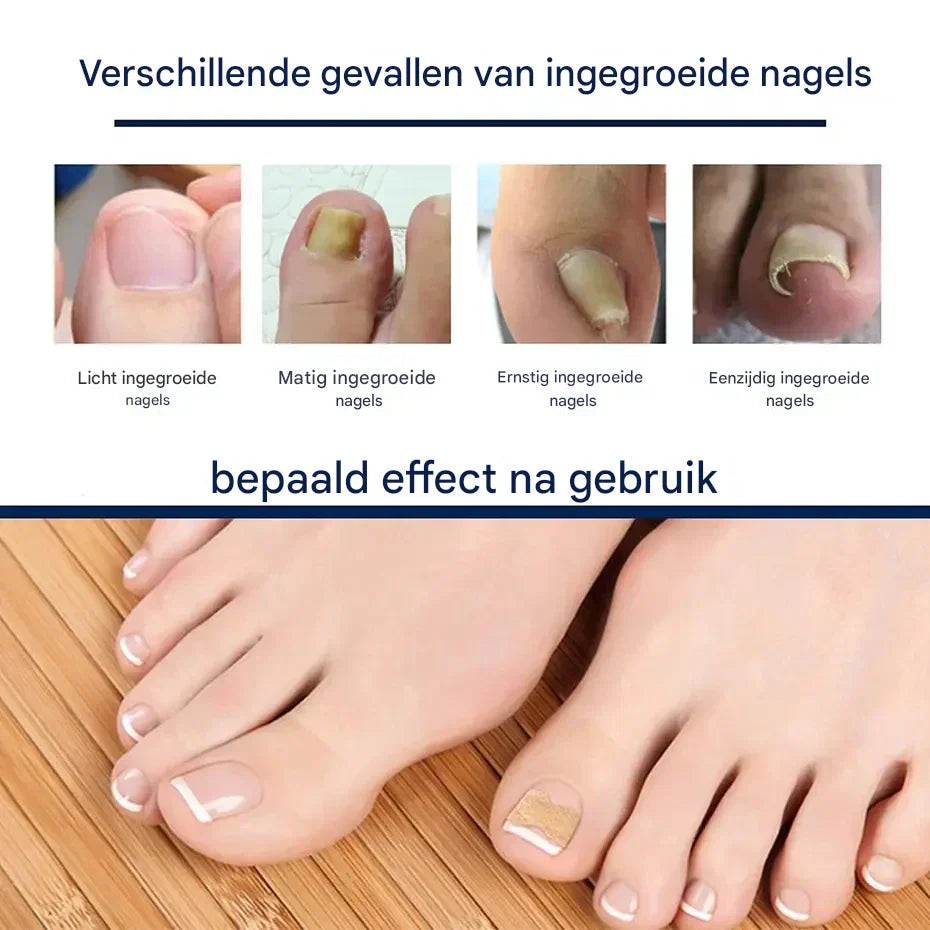 Nail Correction Strips for Ingrown & Uneven Nails – 50 Pieces