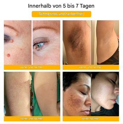 TagAway™ – Effective Removal of Warts & Skin Growths for Smooth, Clear Skin [1 + 1 Free]