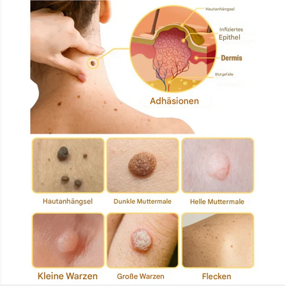 TagAway™ – Effective Removal of Warts & Skin Growths for Smooth, Clear Skin [1 + 1 Free]