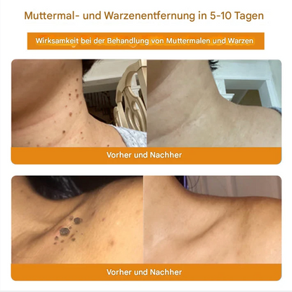 TagAway™ – Effective Removal of Warts & Skin Growths for Smooth, Clear Skin [1 + 1 Free]