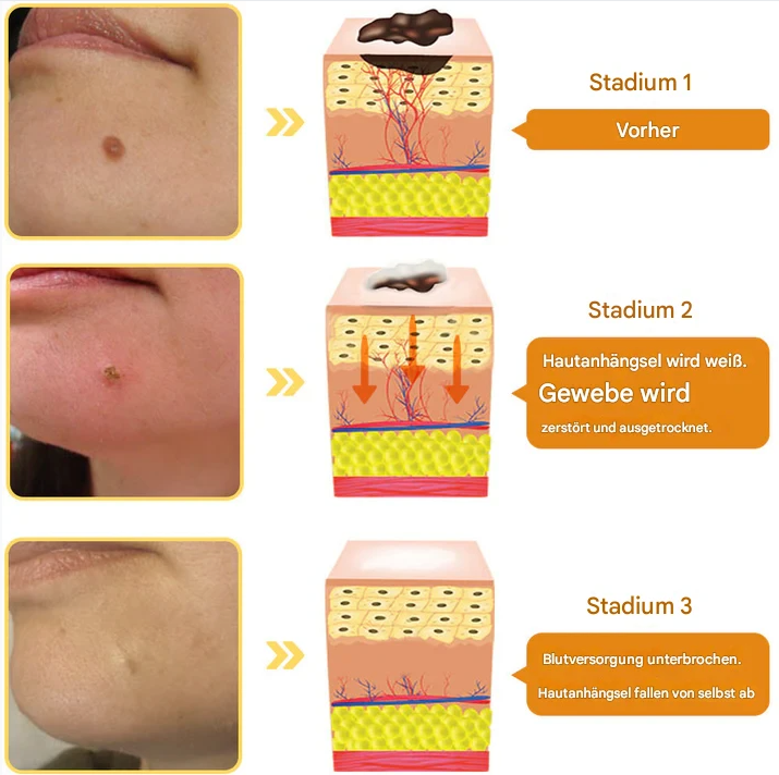 TagAway™ – Effective Removal of Warts & Skin Growths for Smooth, Clear Skin [1 + 1 Free]