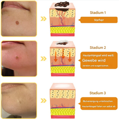 TagAway™ – Effective Removal of Warts & Skin Growths for Smooth, Clear Skin [1 + 1 Free]