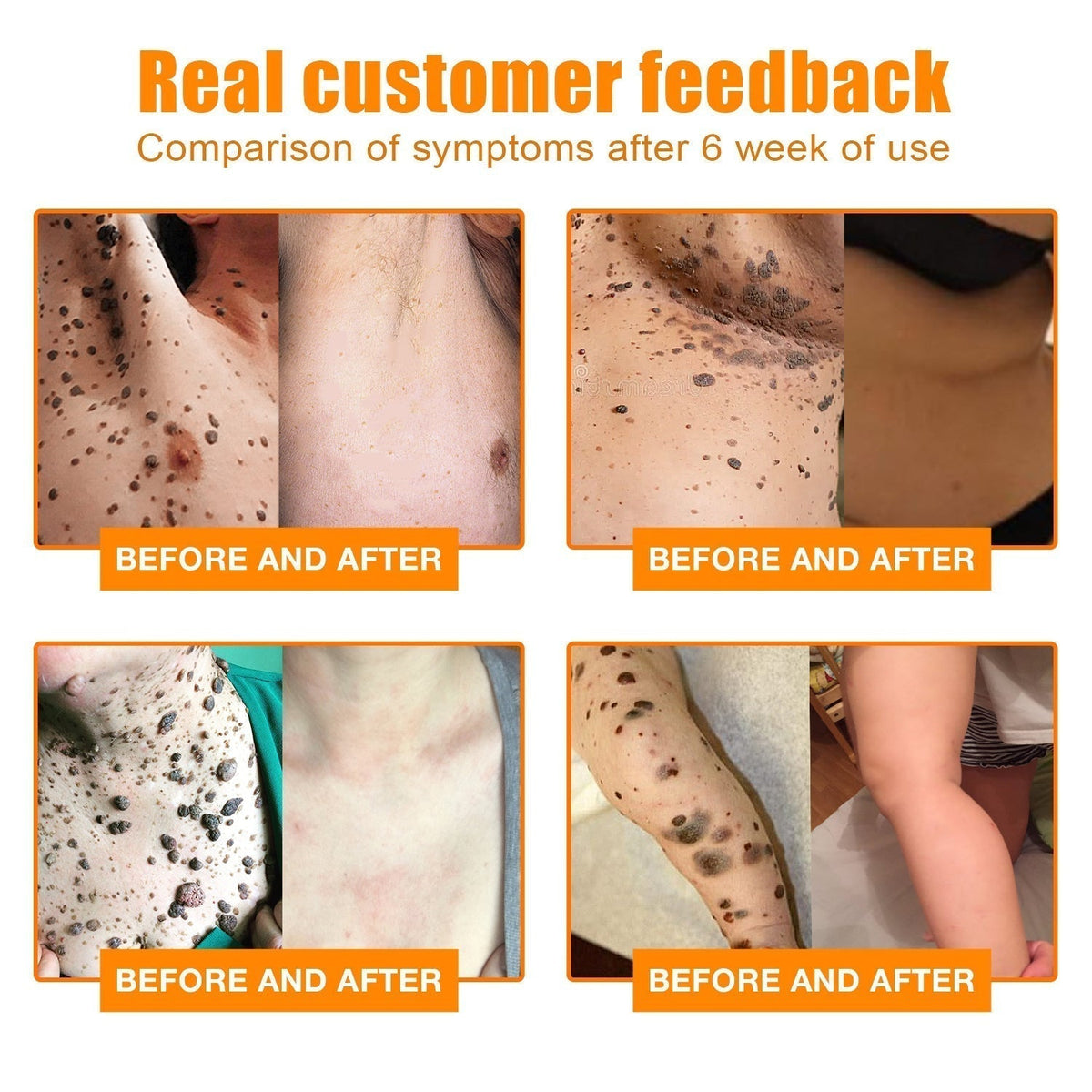 Bee Venom Skin Tag Removal Cream for Face and Body