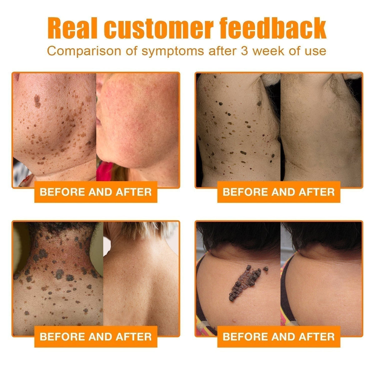 Bee Venom Skin Tag Removal Cream for Face and Body
