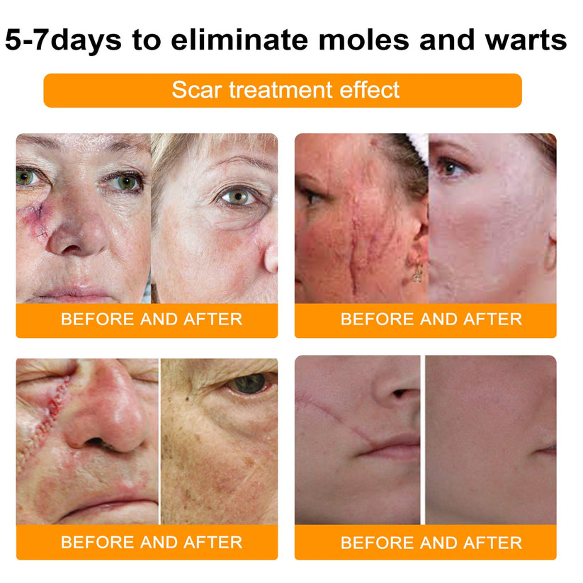 Bee Venom Skin Tag Removal Cream for Face and Body