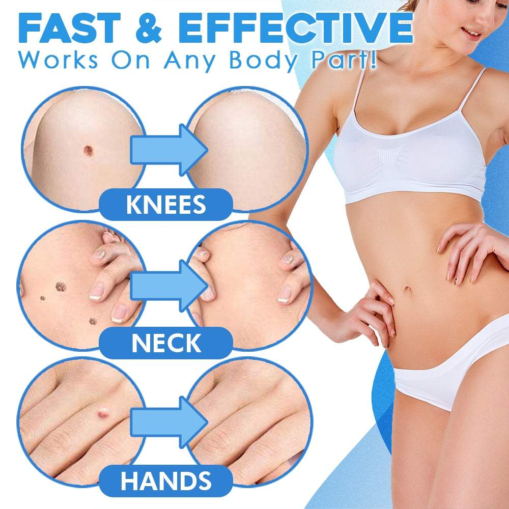 FlawFix™ – Wart Removal Set for Gentle, Effective & Safe Removal [50% Off]