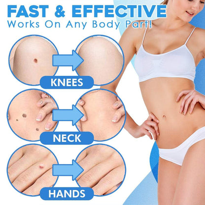 FlawFix™ – Wart Removal Set for Gentle, Effective & Safe Removal [50% Off]